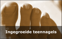 Ingegroeide teennagels