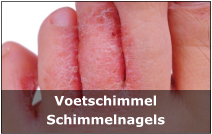 Voetschimmel Schimmelnagels