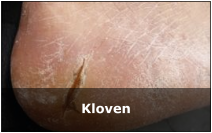 Kloven