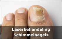 Laserbehandeling Schimmelnagels